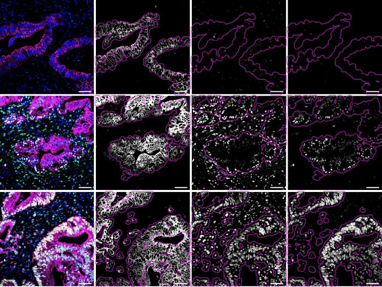 How the immune system influences pancreatic cancer