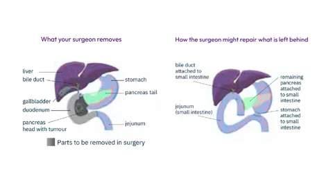 Whipple procedure - organs removed by the surgeon