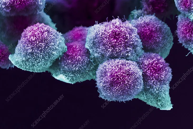 C0460869 Pancreatic Cancer Cell, SEM
