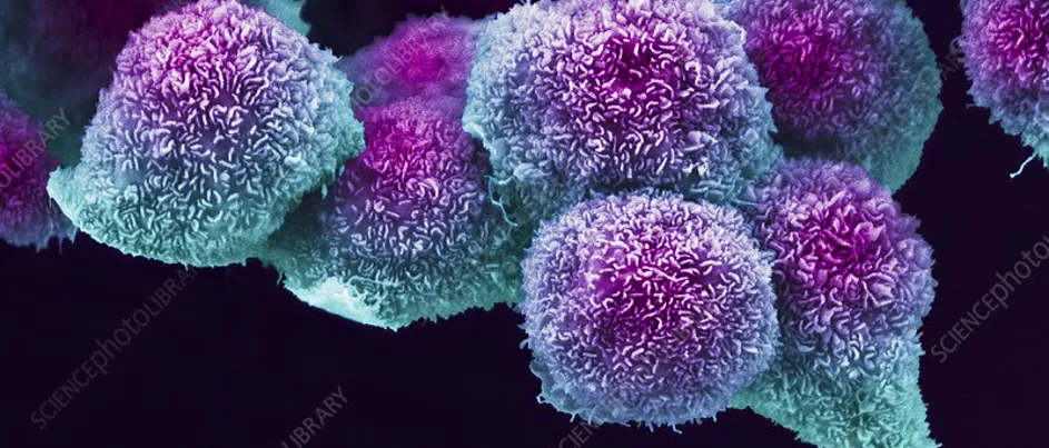 pancreatic cancer cells